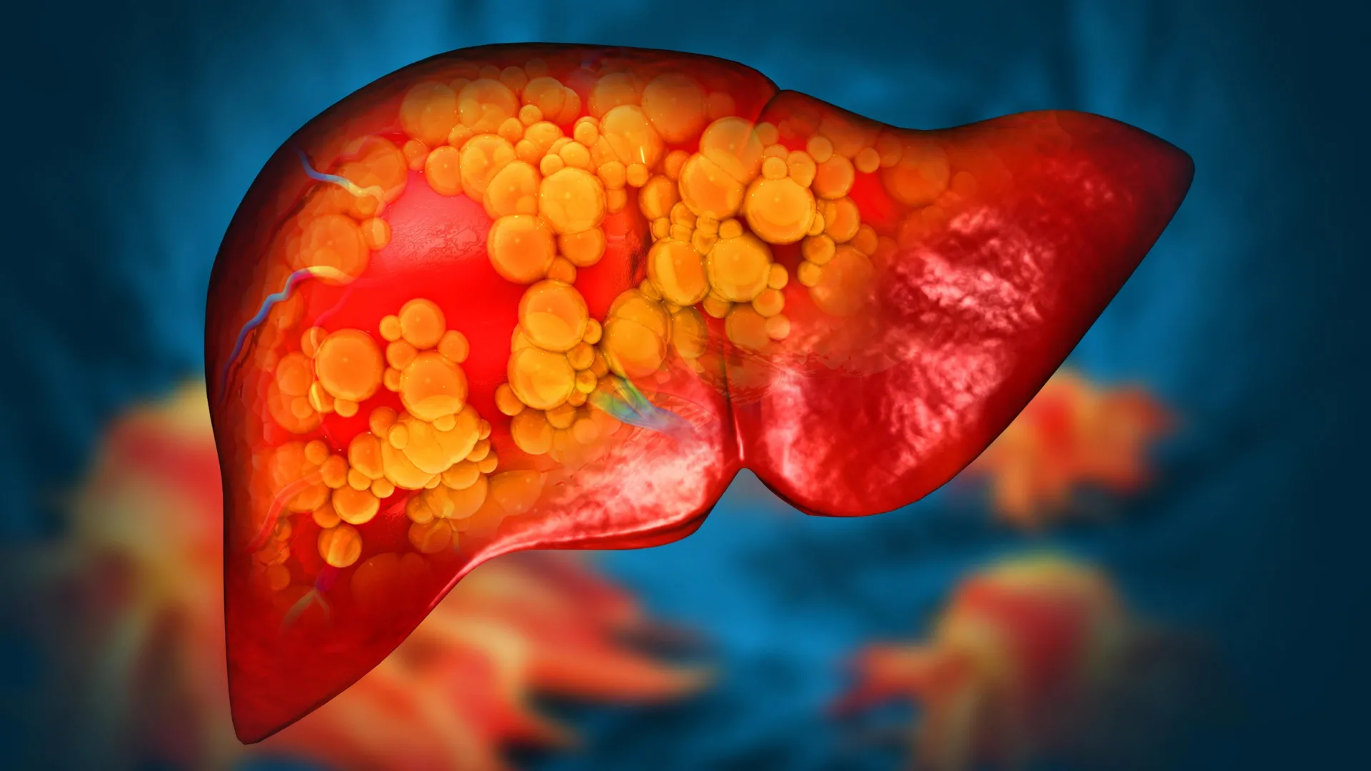 Experimental Drug ION224 Shows Promise Against Aggressive Fatty Liver Disease