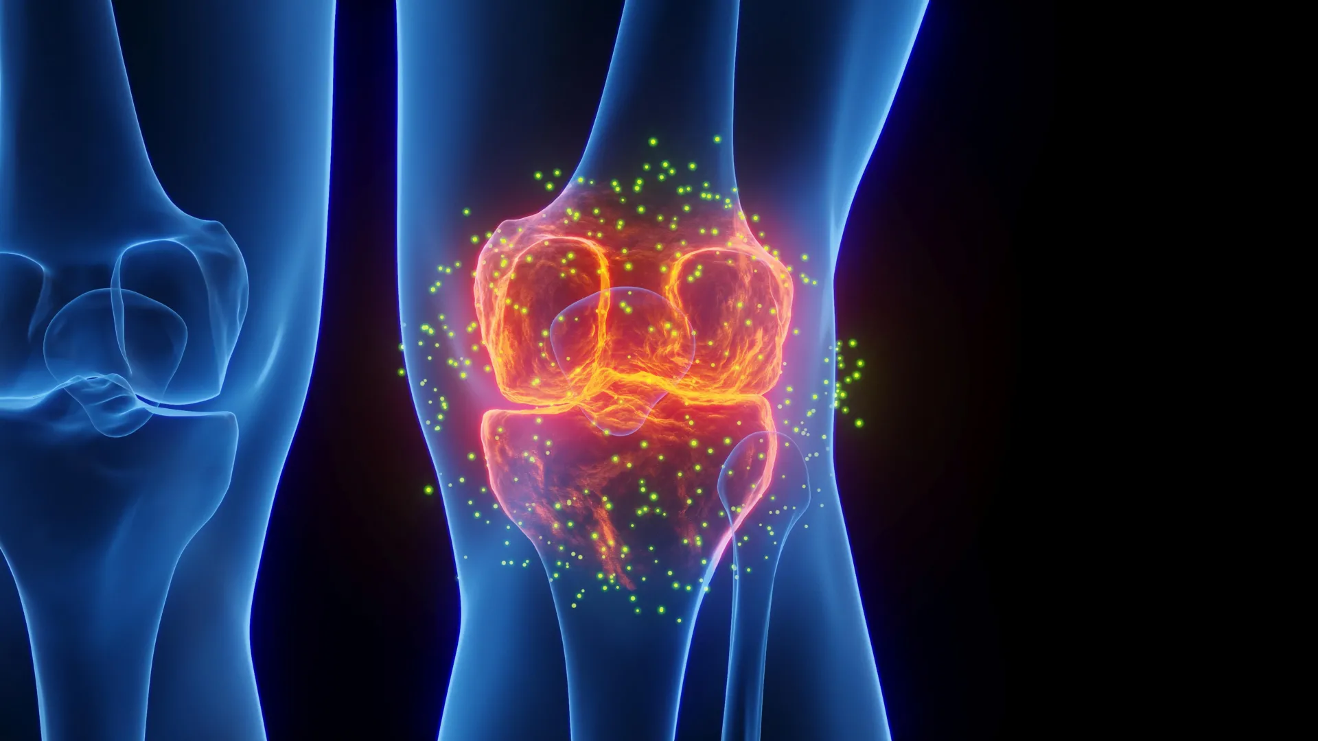 Minimally Invasive Procedure Offers Knee Pain Relief Without Major Surgery