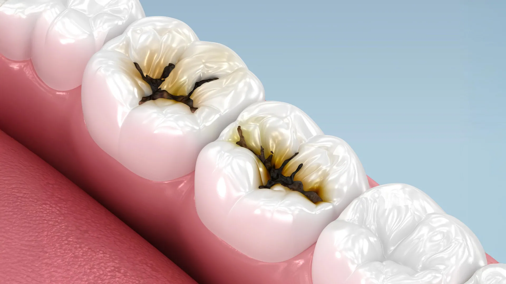 Silver Diamine Fluoride Stops Cavities in Young Children Without Drilling